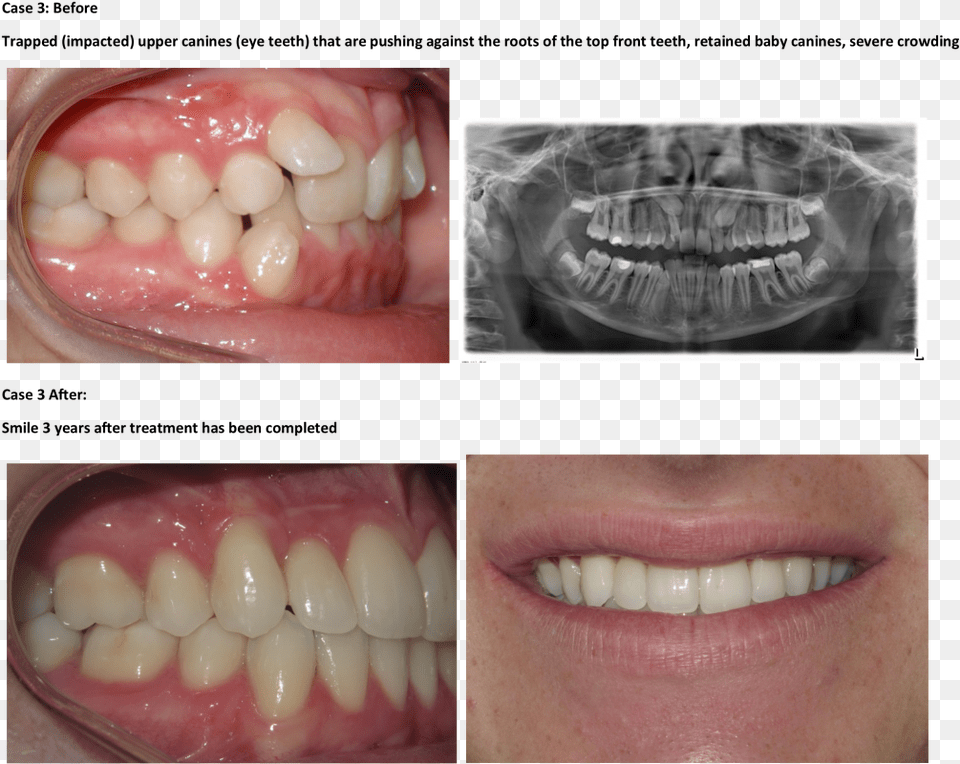 Bad Teeth Braces Before And After, Body Part, Person, Mouth, Baby Free Png