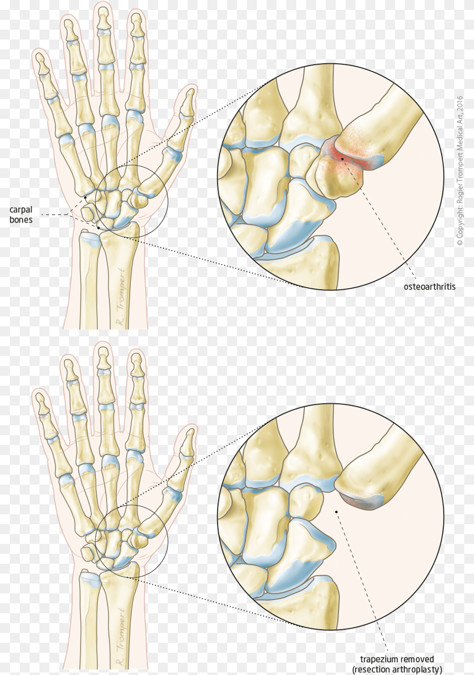 Base Of Thumb Osteoarthritis Circle, Person Png Image