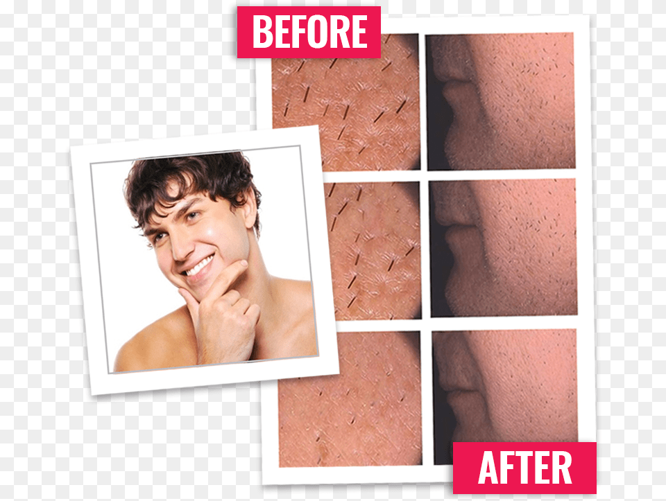 Beard Removal, Art, Body Part, Person, Collage Free Png Download