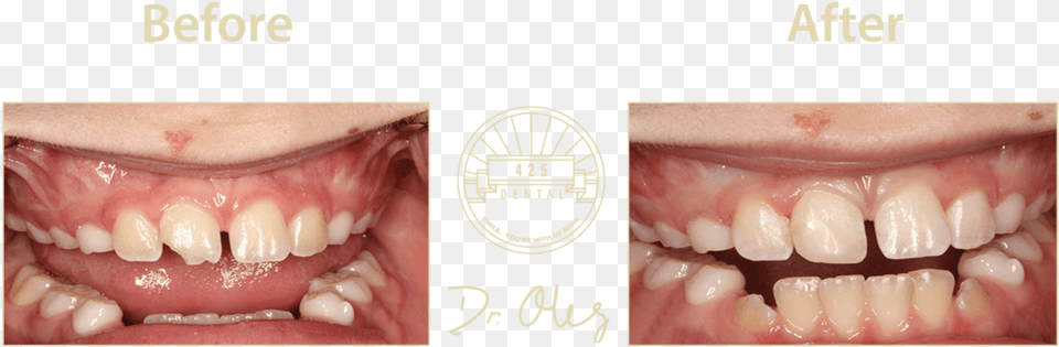 Before After Cosmetic22 Tongue, Body Part, Mouth, Person, Teeth Png Image
