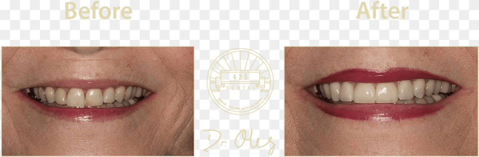 Before After Cosmetic34 Portable Network Graphics, Body Part, Mouth, Person, Teeth Png Image