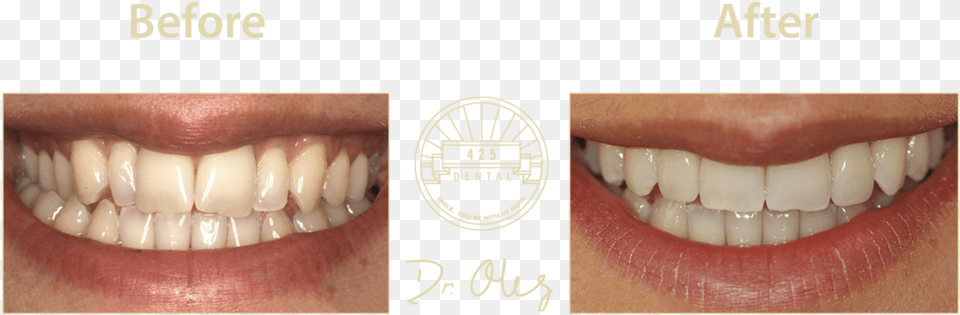 Before After Invisaline3 Portable Network Graphics, Body Part, Mouth, Person, Teeth Free Transparent Png