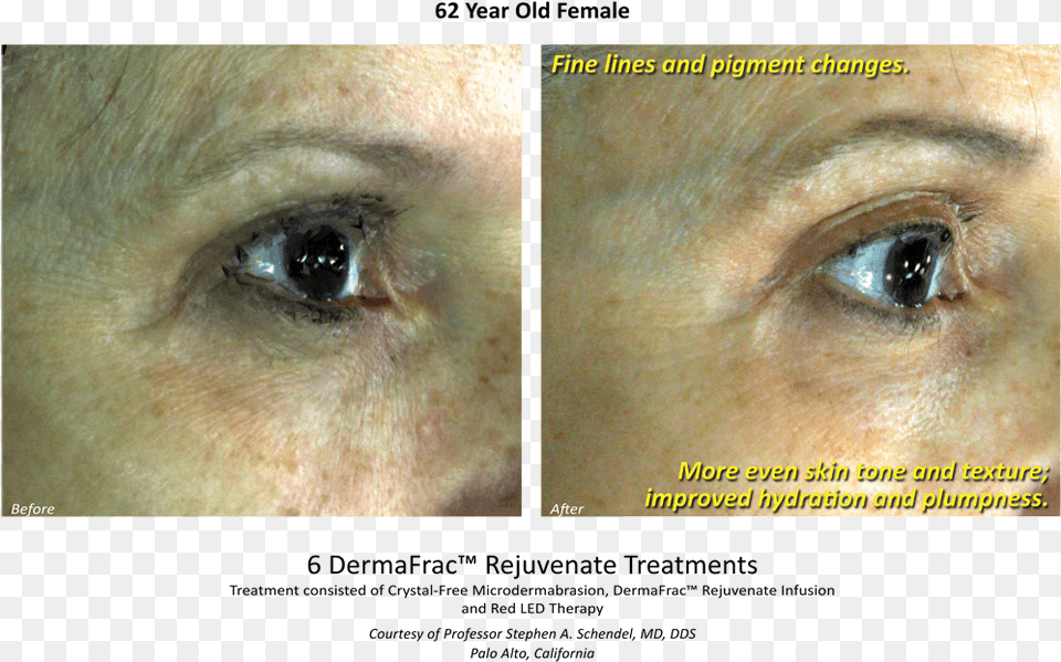 Before Amp After Dermafrac Skin Rejuvenation Injections Poster, Art, Collage, Face, Head Free Png