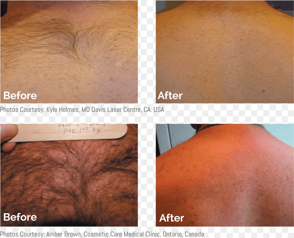 Before Amp After Mens Laser Hair Removal Back And Shoulders Laser Hair Reduction Men, Body Part, Face, Head, Neck Png