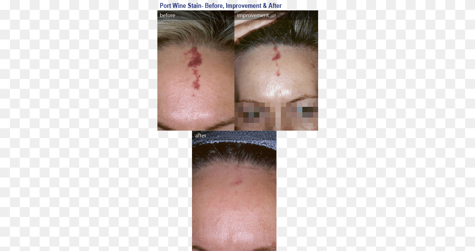 Before Amp After Photos Pulsed Dye Laser Red Scar, Person, Face, Head, Adult Free Png