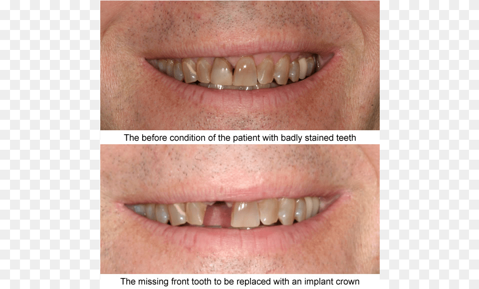 Before And After Case Examples All Of These Cases Shown Tongue, Body Part, Mouth, Person, Teeth Png
