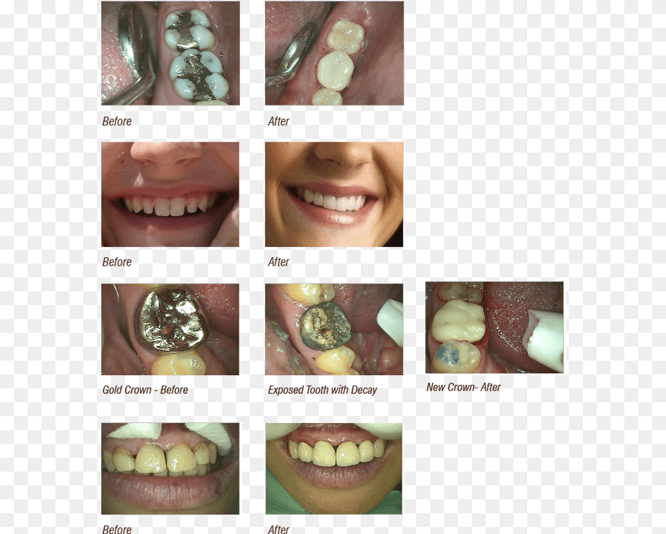 Before And After Cosmetic Dentistry Castle Valley Dental, Body Part, Mouth, Person, Teeth Png Image