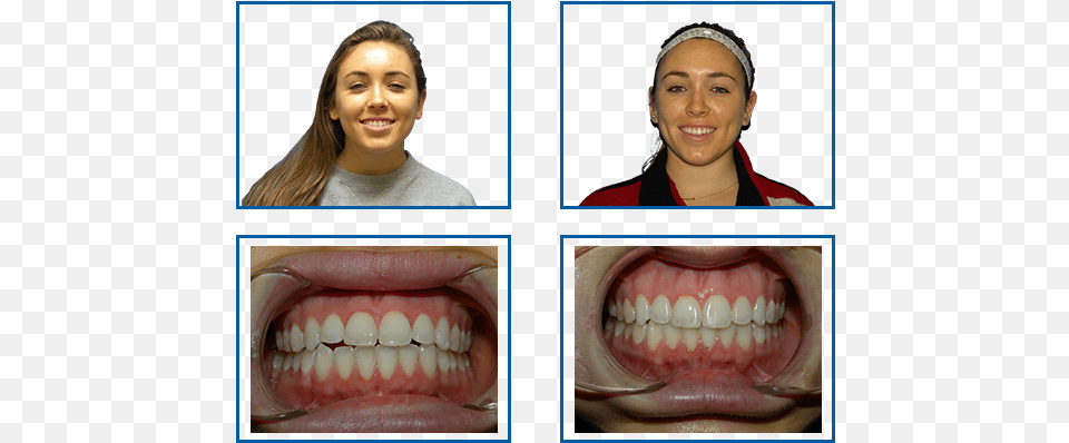 Before And After Overjet, Teeth, Person, Body Part, Mouth Free Png Download