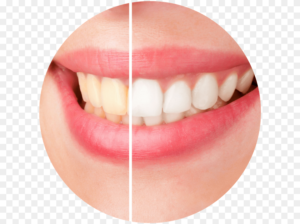 Before And After Teeth Whitening, Body Part, Mouth, Person Free Transparent Png