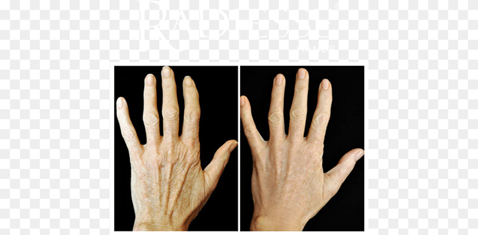 Before And After Treatment With Radiesse Hands Radiesse Hands, Body Part, Finger, Hand, Person Free Png Download