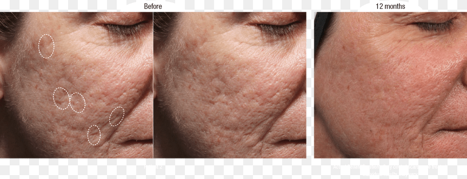 Before And Afters Bellafill For Acne Scars, Face, Head, Person, Baby Free Transparent Png