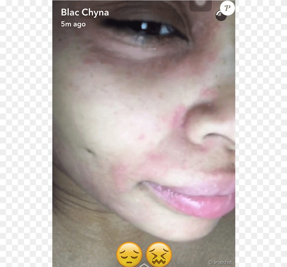 Blac Chyna A Fait Une Raction Allergique Un Soin, Face, Head, Person, Baby Free Png Download