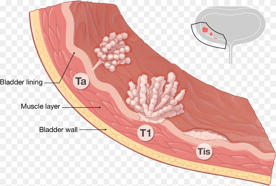 Bladder Cancer Staging, Food, Meat, Pork, Body Part Free Png Download