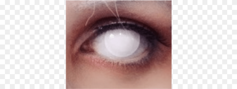 Blind Eye Contact Whiteout, Contact Lens, Baby, Person Free Png Download