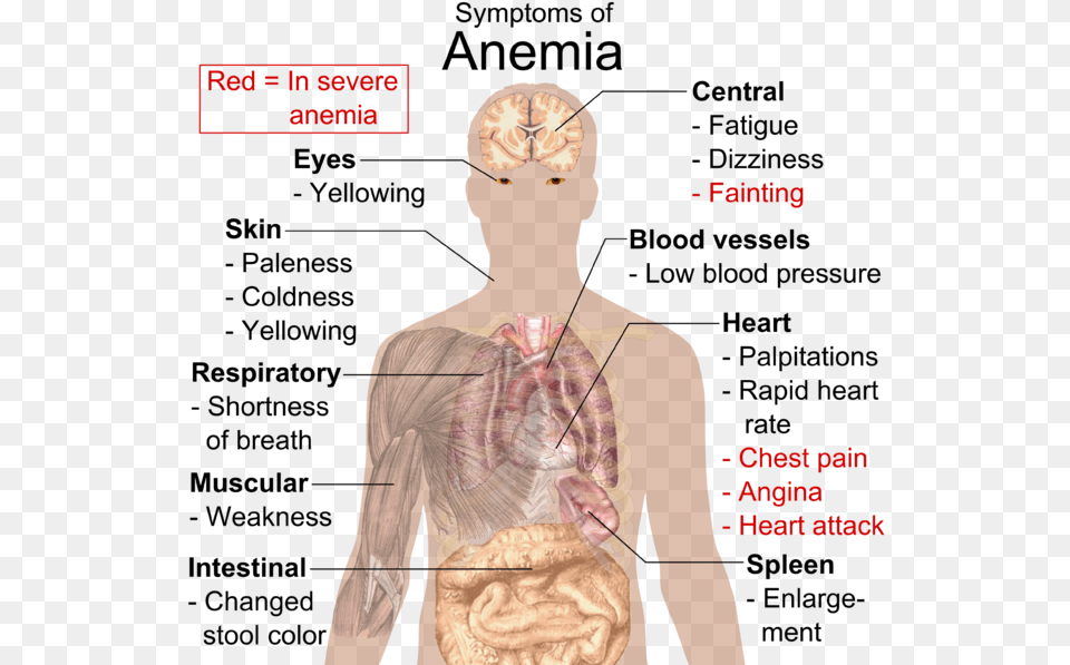 Blood Disorders Anemia Know If You Re Anemic, Adult, Male, Man, Person Free Png