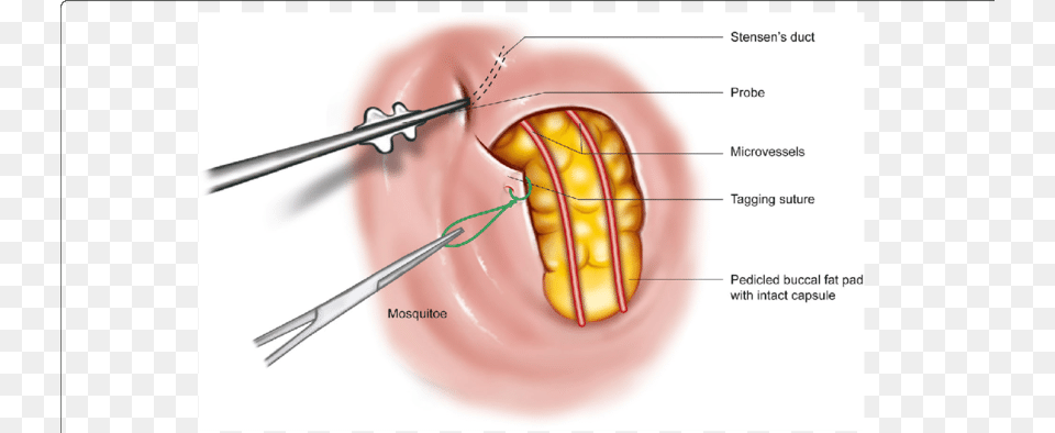 Blunt Transparent Fat Herniation Of Buccal Fat Pad, Body Part, Face, Head, Mouth Png Image