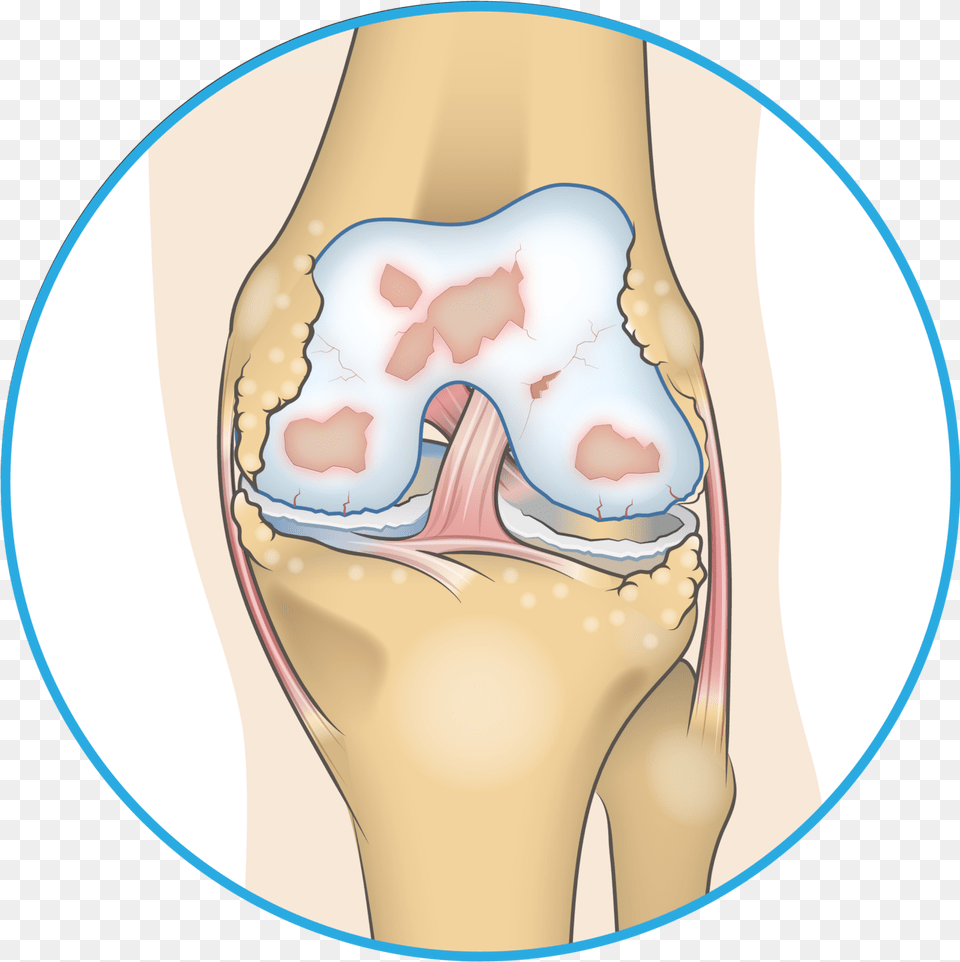 Bone Spur In Knee, Body Part, Face, Head, Neck Free Transparent Png