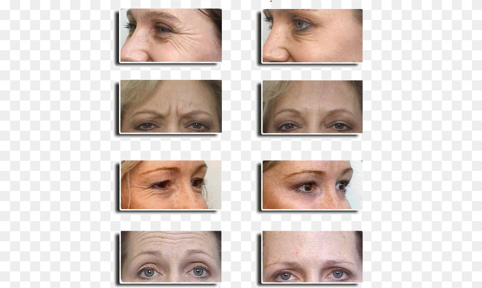 Botox Before And After Botox, Adult, Wedding, Sad, Person Png Image