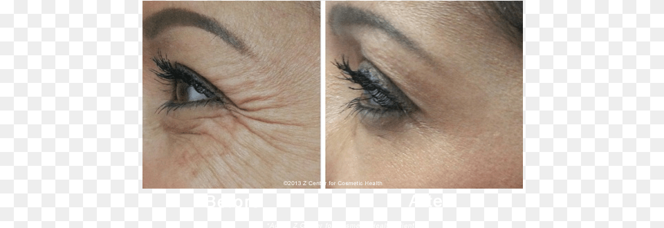 Botox Eye Wrinkles Botox Before And After Under Eye Wrinkles, Face, Head, Person, Adult Png Image