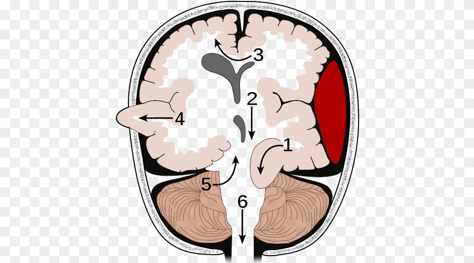 Brain Herniation Types Types Of Brain Herniation, Ct Scan, Baby, Person, Heart Free Png Download