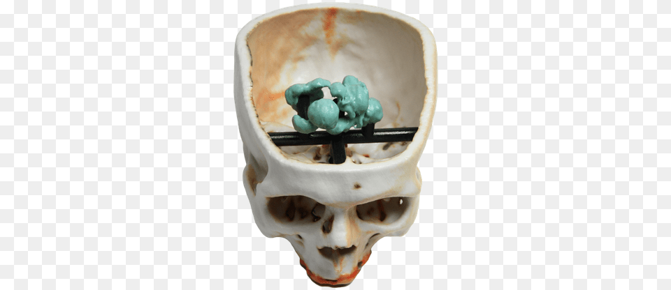 Brain Tumor 3d Print 3d Printing, Accessories, Gemstone, Jewelry, Art Png Image