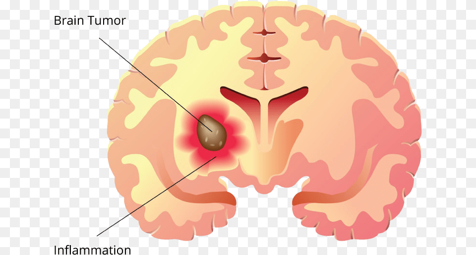 Brain Tumor Label Brain Tumor Clipart Png