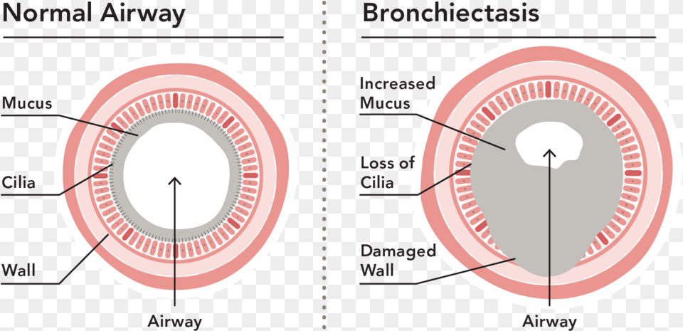 Bronchiectasis Loss Of Cilia Free Png Download