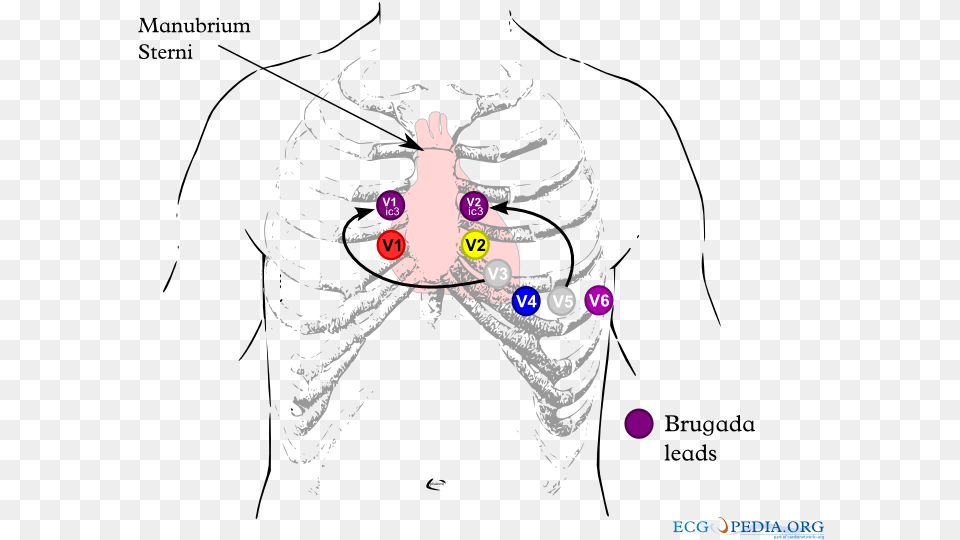 Brugada Lead Placement Brugada Syndrome Ecg Placement, Art, Graphics, Person, Outdoors Png Image