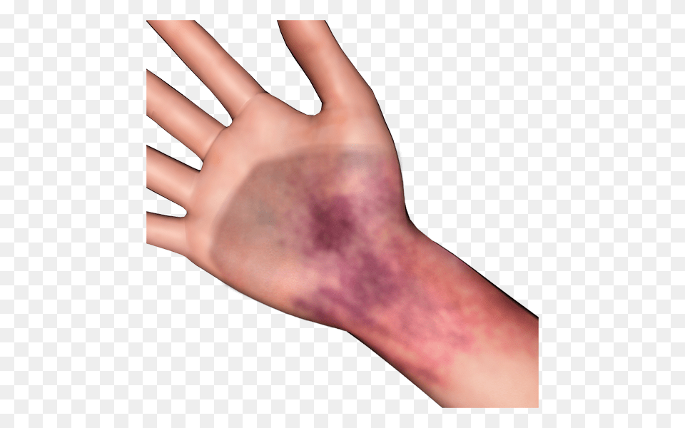 Bruise Photosymbols, Body Part, Hand, Person, Wrist Free Png Download