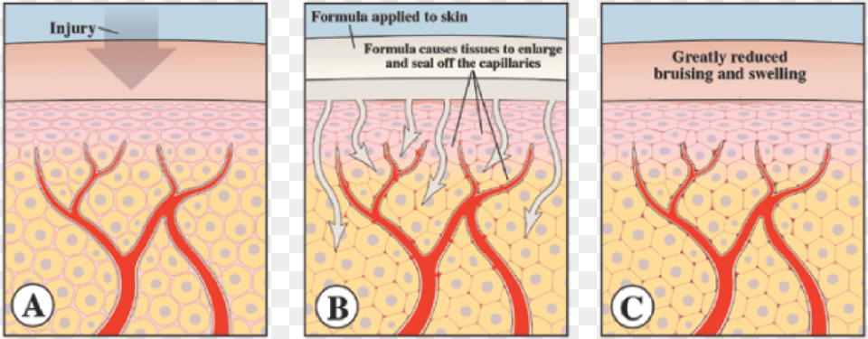 Bruise Repair Formula Bruises How They Are Formed, Book, Publication, Comics Free Transparent Png