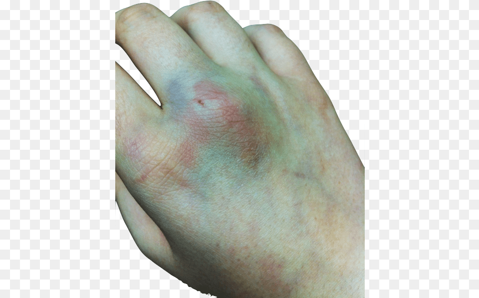 Bruise Tumblr Blood, Body Part, Hand, Person, Skin Free Transparent Png