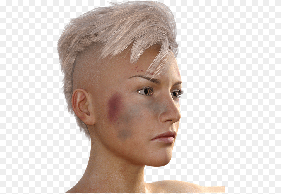 Bruised Jaw Female, Adult, Person, Woman, Hair Free Png Download