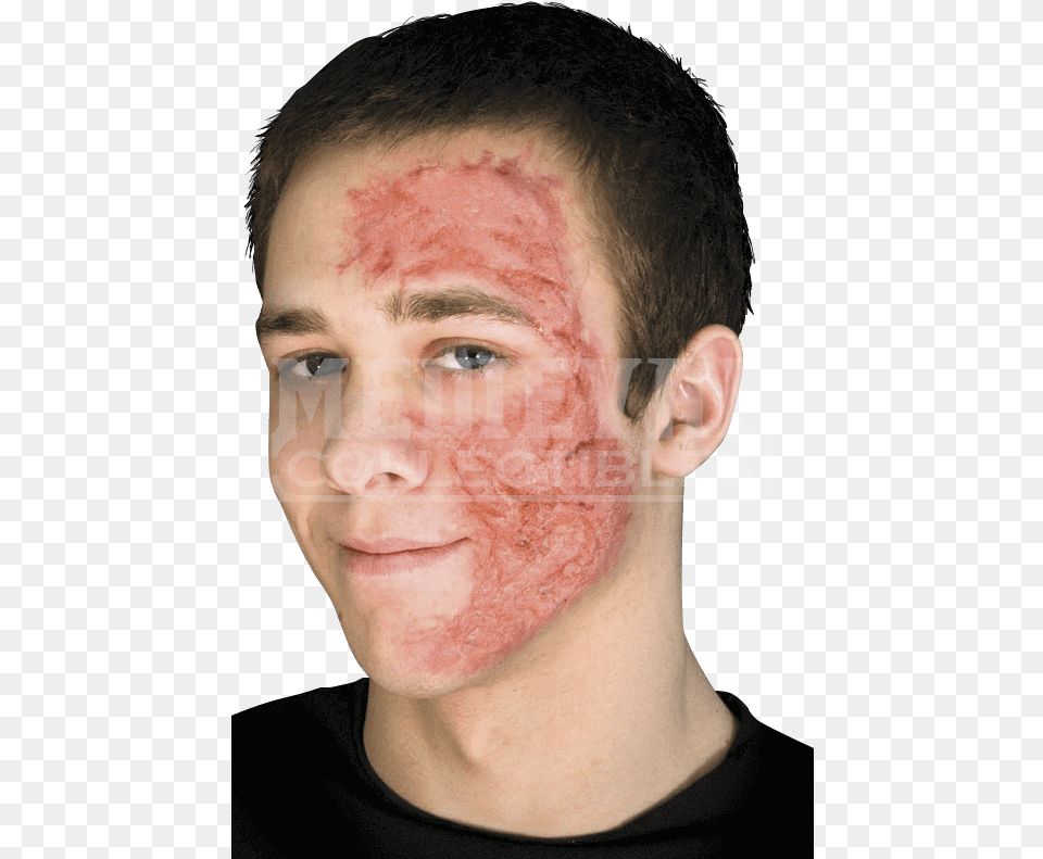 Burn Scar Face Scar On Face From Burn, Adult, Head, Male, Man Png