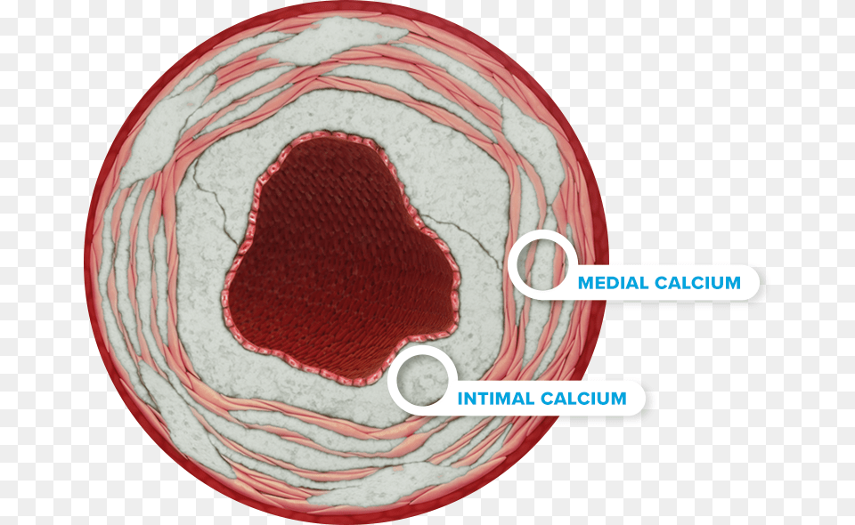 Calcium Right Intimal Calcium, Home Decor Png Image