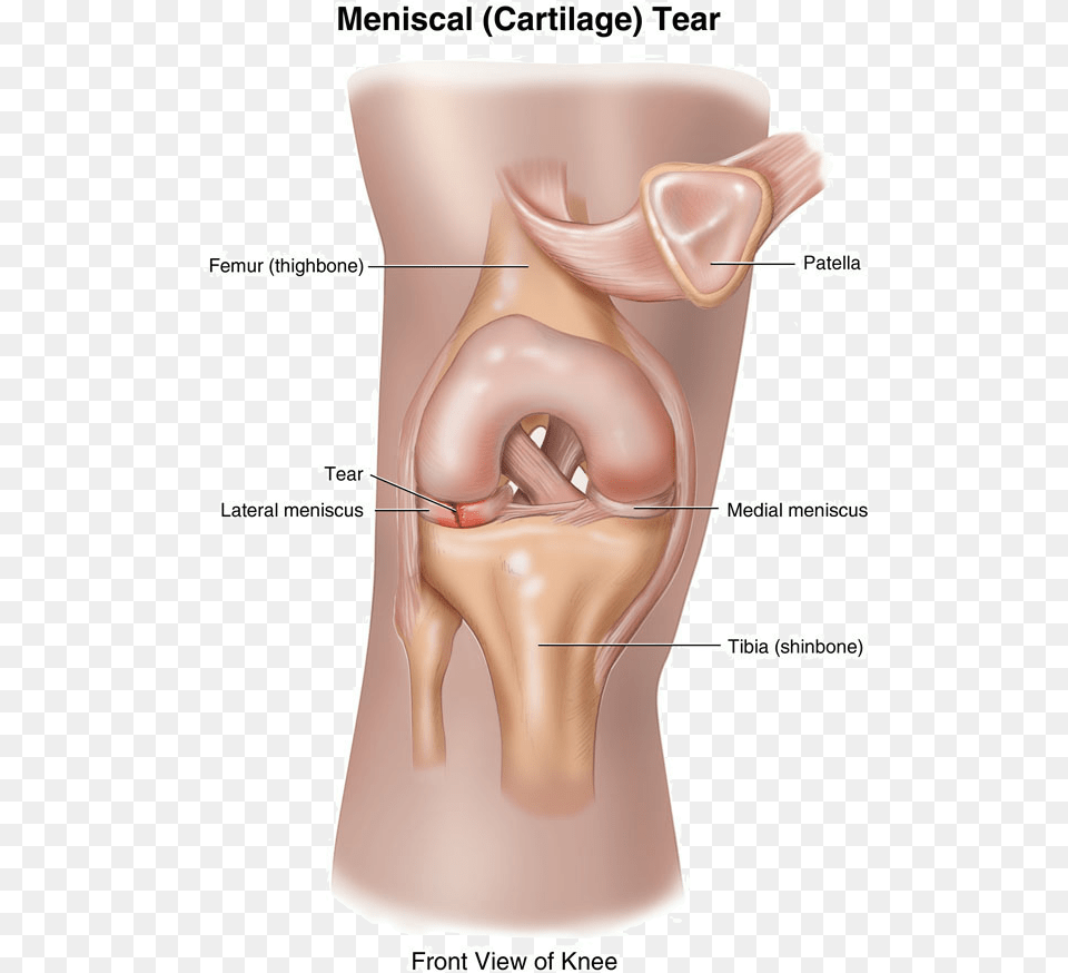 Can A Torn Meniscus Heal Itself Loose Cartilage In Knee, Body Part, Ear, Adult, Female Png Image