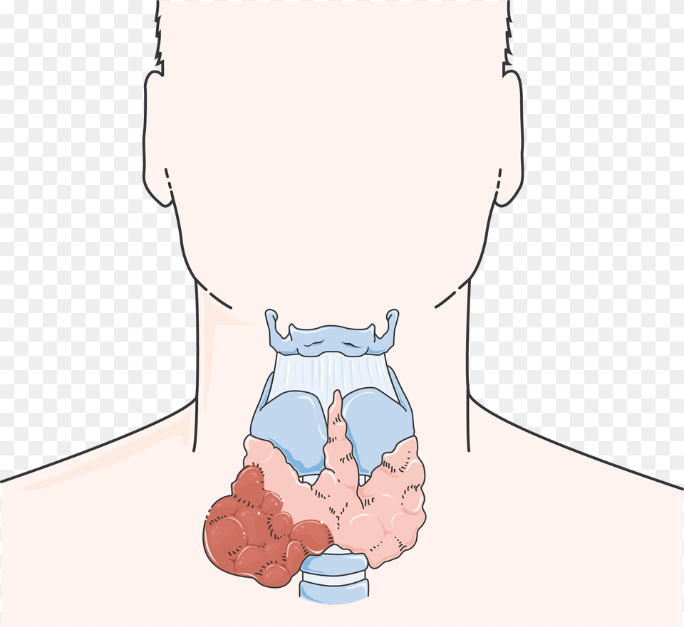Cancer De La Thyrode Thyroid Cancer Cartoon, Face, Head, Person Png Image