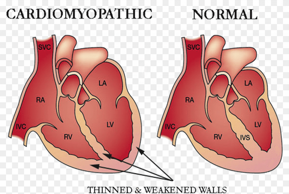 Cardiomyopathy Heart, Baby, Person, Face, Head Png Image