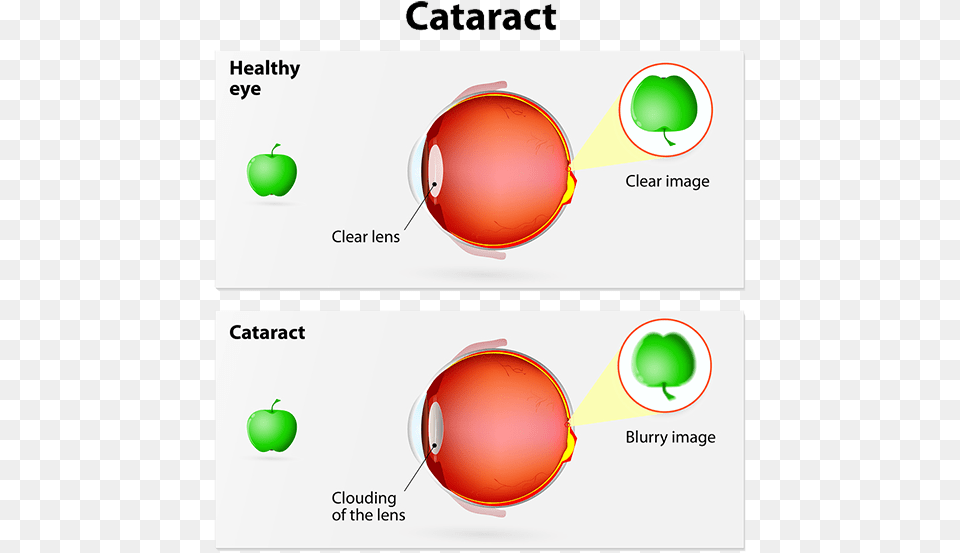 Cataract Cataract Ray Diagrams, Sphere Png Image