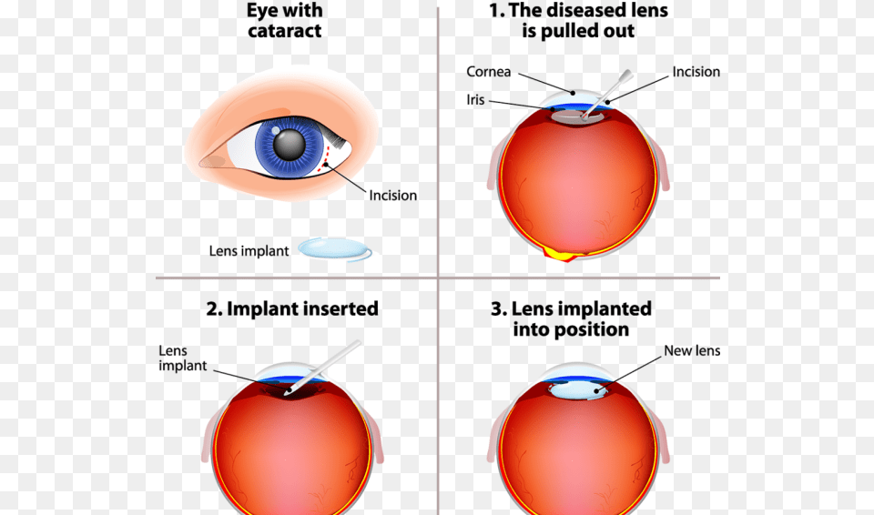 Cataracts Are One Of The Main Causes Of Blindness And Cataract Surgery, Computer Hardware, Electronics, Hardware, Mouse Free Png Download