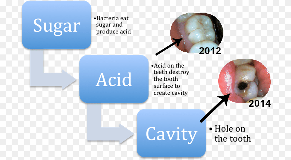 Cavities Diagram, Body Part, Mouth, Person, Teeth Png