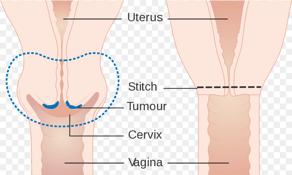 Cervical Amputation Illustration, Chart, Plot, Adult, Female Free Png