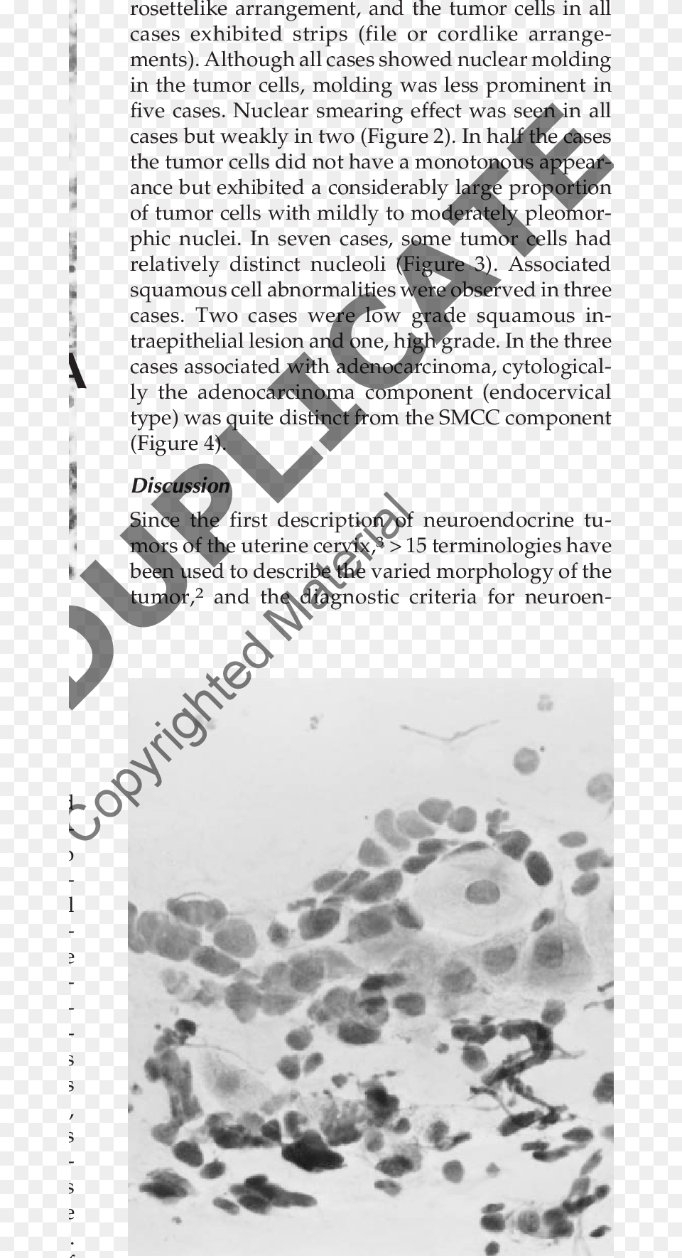 Cervical Smear Of Smcc Of The Cervix, Footprint, Person Png Image