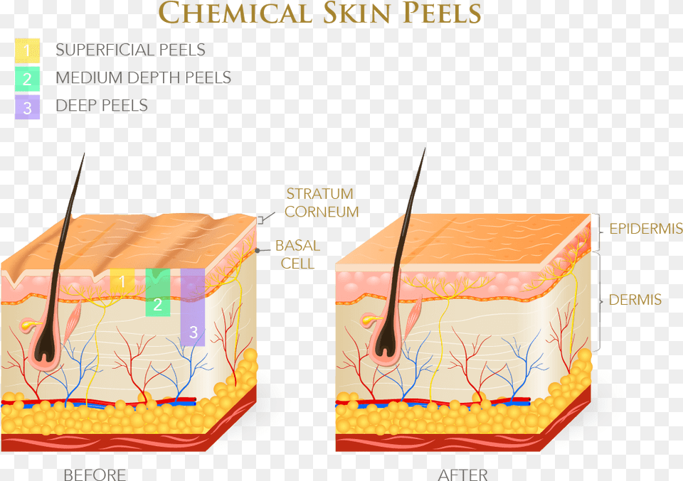 Chemical Peels Come In Different Strengths And The Oily Amp Dry Skin, Birthday Cake, Cake, Cream, Dessert Free Transparent Png