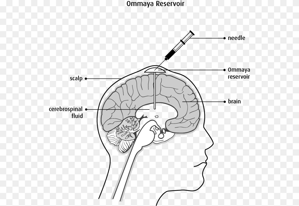 Chemotherapy For Brain Tumor, Art, Drawing, Ct Scan Png