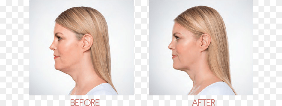 Chin Fat Removal, Neck, Body Part, Face, Person Png Image