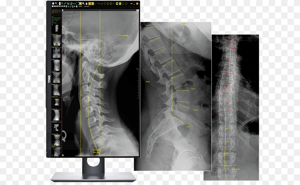 Chiropractic X Ray Machines, Ct Scan, Adult, Bride, Female Png