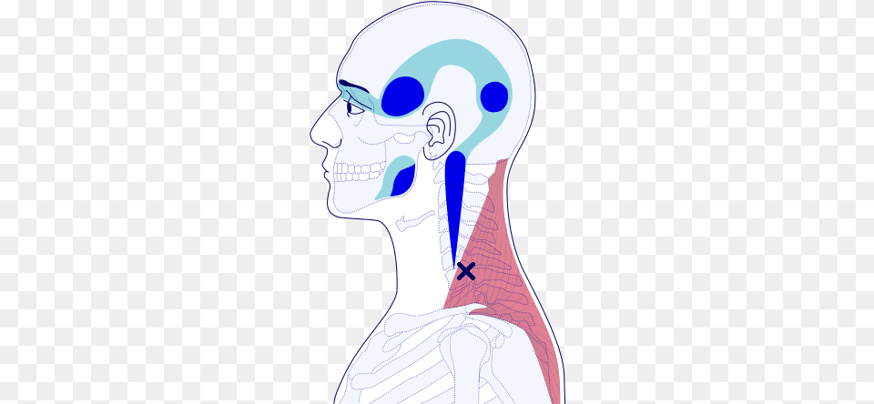 Classic Question Mark Pain Brought About Through Myofascial Trigger Point, Body Part, Face, Head, Neck Png Image