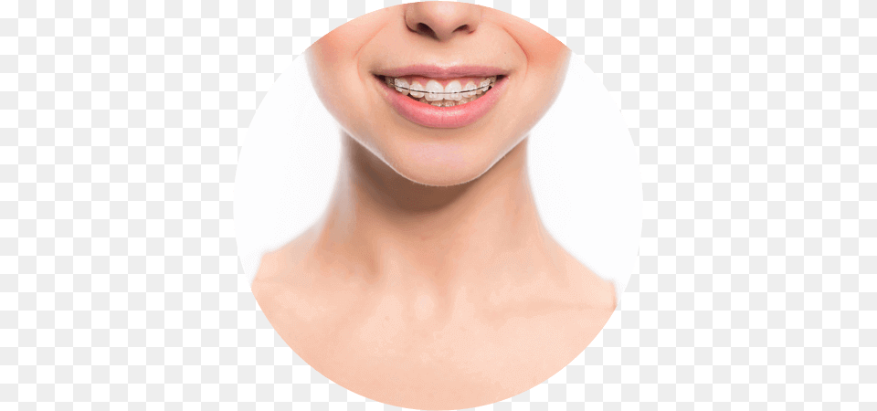 Clear Braces Dental Braces, Body Part, Face, Head, Mouth Free Png Download