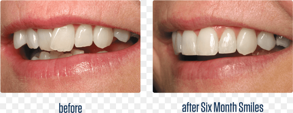 Clear Bracket Braces Before And After, Body Part, Mouth, Person, Teeth Free Transparent Png