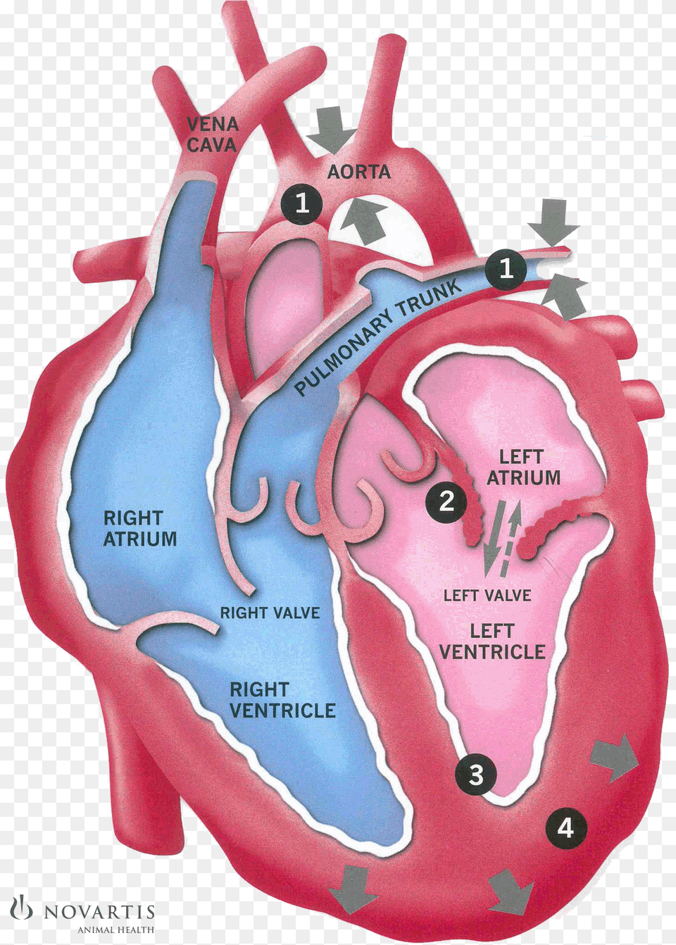 Clip Art Congestive Heart Failure Picture Heart Failure Back Flow, Baby, Person, Body Part, Stomach Free Png